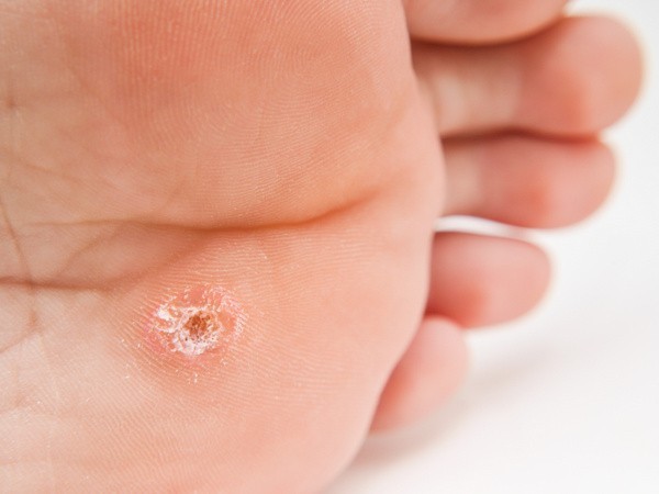 Dornwarze? (© Arve Bettum - Fotolia.com)
