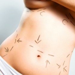 Abdominoplastik: Erst lesen, dann Bauchdeckenstraffung Abdominoplastik - Markierungen an einem schlanken Modell © Benko Zsolt - Fotolia.com