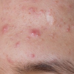 Was hilft gegen Pickel und Akne? – Hausmittel und Medikamente gegen die nervigen Mitesser Mitesser, Pickel, Akne: Ein unschönes Problem, nicht nur im Teenager-Alter (© olavs / Fotolia)