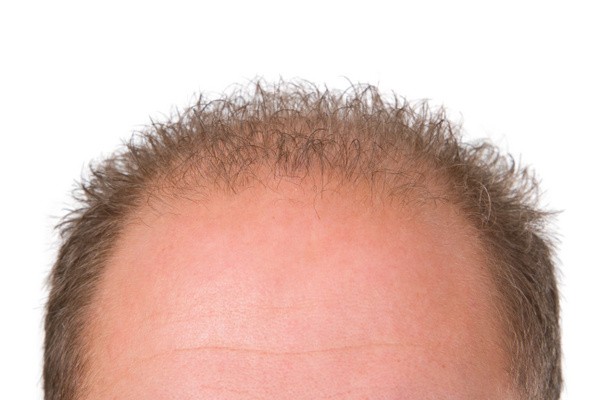 Haarverpflanzung? (© Birgit Reitz-Hofmann / Fotolia)