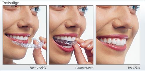 Invisalign Zahnspange (Screenshot www.epsomdentists.co.nz/wp-content/uploads/2012/12/invisalign-auckland-treatment-dental.jpg)