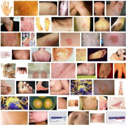 Pilzerkrankungen: Ursprung, Ansteckung, Therapie-Möglichkeiten Pilzerkrankungen an der Haut - Bilder (Screenshot Google Bildsuche am 13.06.2013)