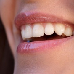 Zähne verblenden: Was kostet’s? Zahnverblendungen sind nicht günstig. Allerdings kann man ein unschönes Erscheinungsbild einzelner Zähne sehr gut kaschieren, indem man sich die Zähne mit Veneers verblenden lässt. (© Mars/Fotolia)