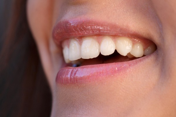 Zahnverblendungen sind nicht günstig. Allerdings kann man ein unschönes Erscheinungsbild einzelner Zähne sehr gut kaschieren, indem man sich die Zähne mit Veneers verblenden lässt. (© Mars/Fotolia) Zahnverblendungen sind nicht günstig. Allerdings kann man ein unschönes Erscheinungsbild einzelner Zähne sehr gut kaschieren, indem man sich die Zähne mit Veneers verblenden lässt. (© Mars/Fotolia)