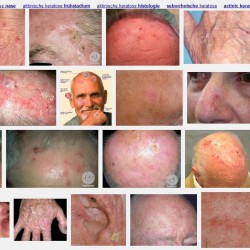 Aktinische Keratose – Hautkrebs? Aktinische Keratose - Beispielbilder | Eine Bildrecherche in der Google-Bildersuche zeigt verschiedene Ausprägungen der Erkrankung (Screenshot images.google.de am 08.08.2014)