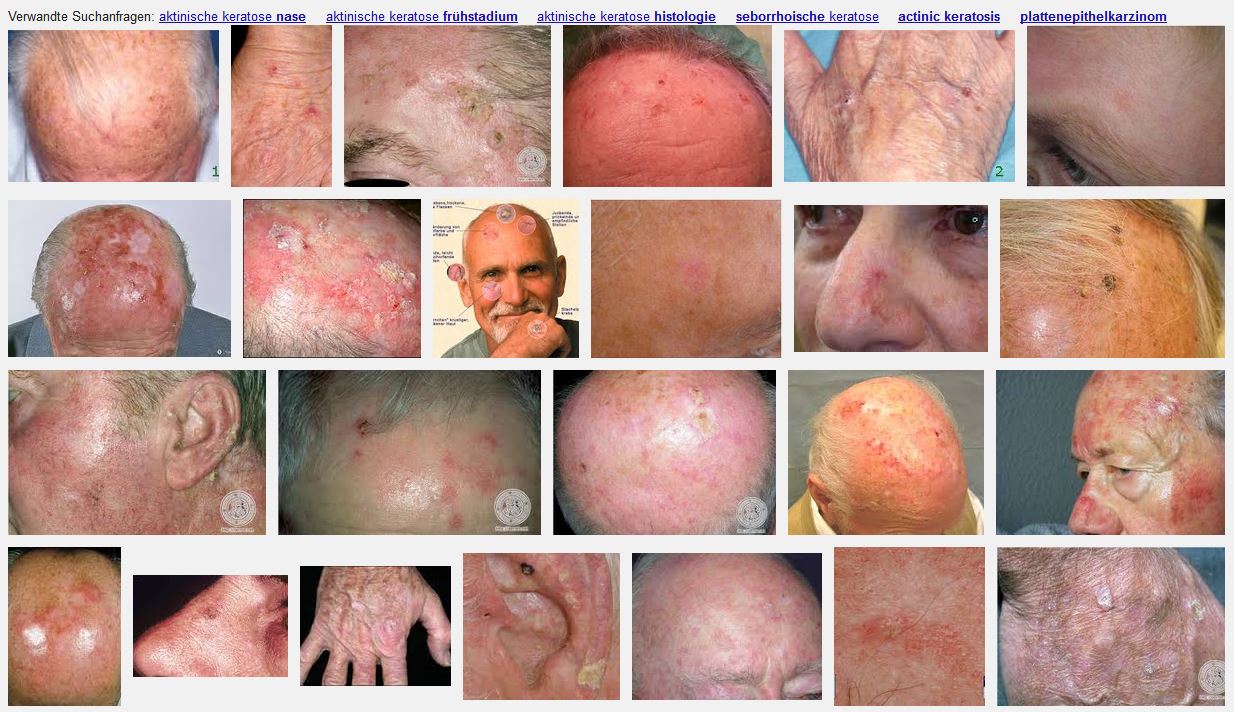 Aktinische Keratose Hautkrebs?