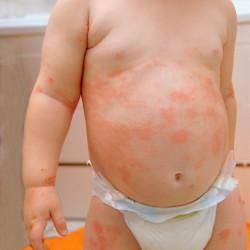Baby Neurodermitis: Was hilft, was tun? Baby Neurodermitis (© lisalucia - Fotolia.com)