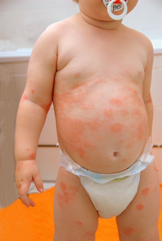 Baby Neurodermitis (© lisalucia - Fotolia.com)