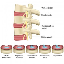 Bandscheibenvorfälle: Behandlung der Bandscheibe und minimal-invasive Operationsmöglichkeiten Bandscheibenvorfall - Wirbelsäule (© bilderzwerg / Fotolia)