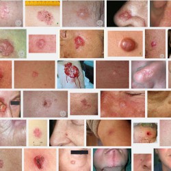 Entfernung eines Basaliom Basaliom Bilder (Screenshot der Google Bildersuche am 08.08.2014)