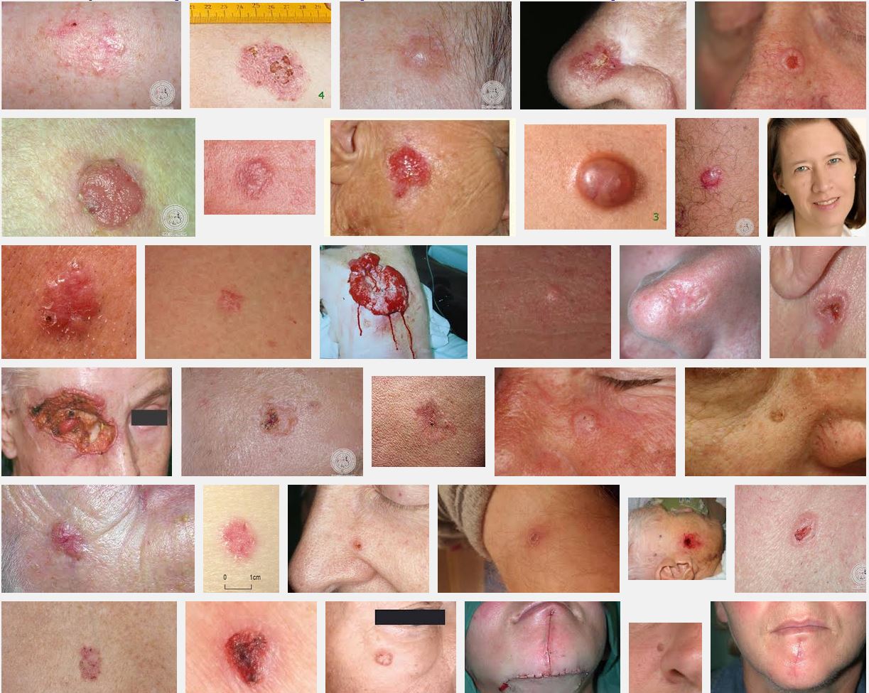 Basaliom Bilder (Screenshot der Google Bildersuche am 08.08.2014)