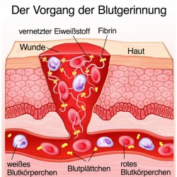 Marcumar-Nekrose: Nebenwirkung der Blutgerinnungshemmung Der Vorgang der Blutgerinnung (© Henrie - Fotolia.com)