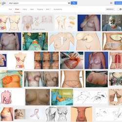 Brustrekonstruktion nach Brustkrebs: Methoden im Überblick DIEP-Lappen-Technik zur Brustrekonstruktion: Bilder und Illustrationen > Screenshot der Google Bildersuche am 27.10.2014