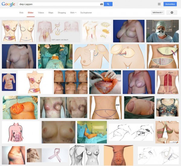 DIEP-Lappen-Technik zur Brustrekonstruktion: Bilder und Illustrationen > Screenshot der Google Bildersuche am 27.10.2014