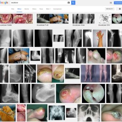 Exostose | Krankhafte Neubildung von Knochen Exostosen in Bildern: Exostose an Kiefer, Fuß, Knie und Ohr (Screenshot Google Bildersuche)