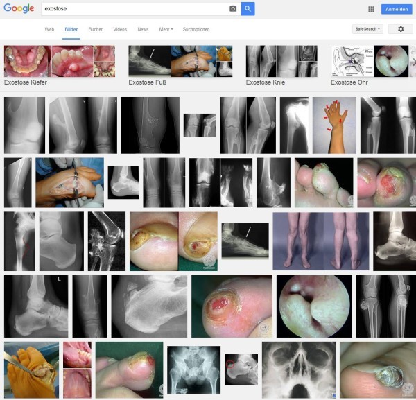 Exostosen in Bildern: Exostose an Kiefer, Fuß, Knie und Ohr (Screenshot Google Bildersuche)