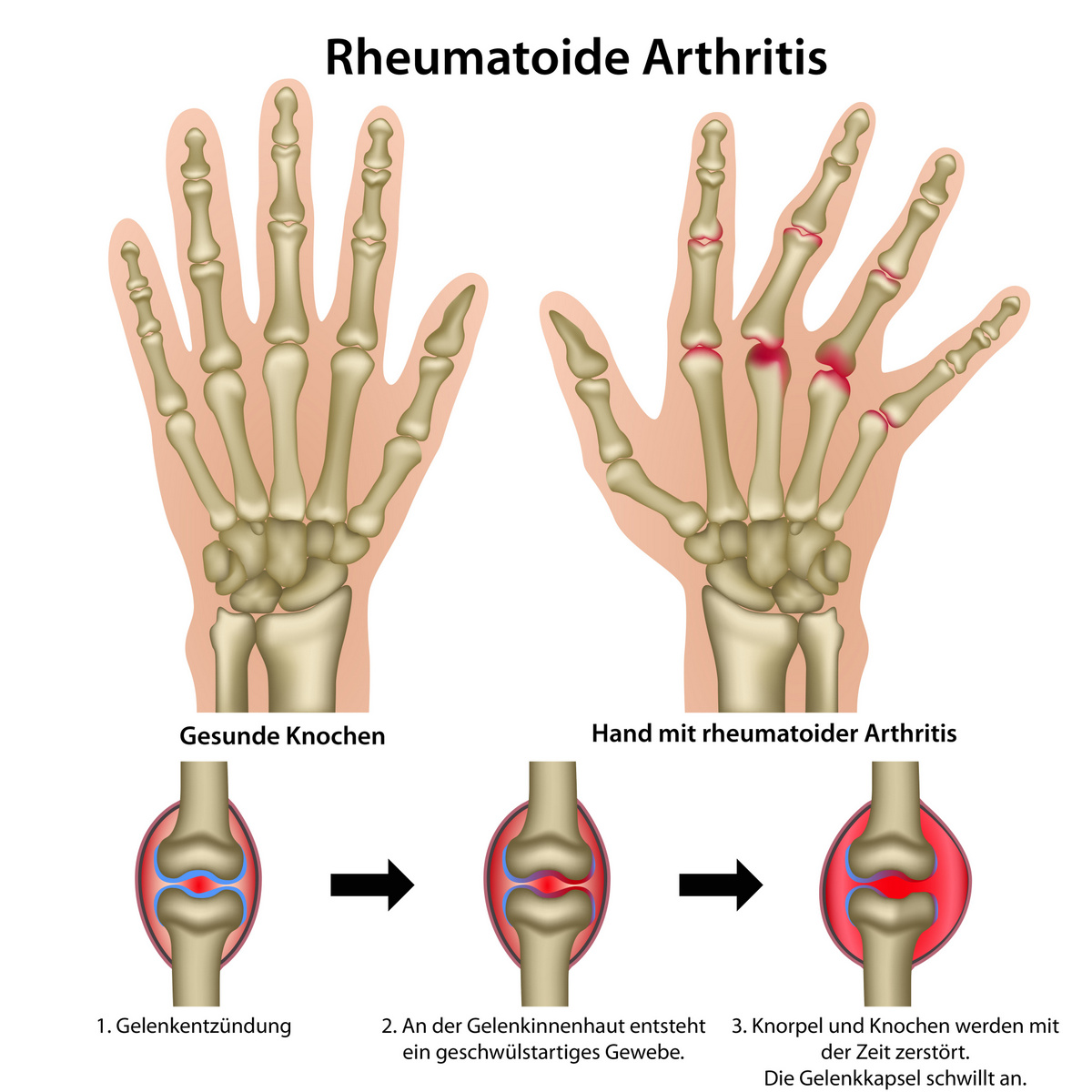 Schmerzen an den Fingergelenken durch rheumatoide Arthritis (Arthrose)?