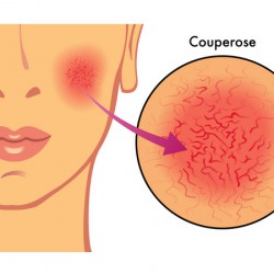 Gefäßerweiterung als kosmetisches Problem Gefäßerweiterung / Couperose (© rob3000 - Fotolia.com)