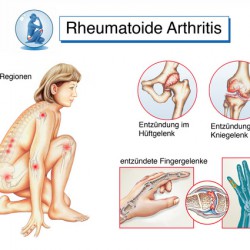 Gelenkschmerzen | Was tun, wenn die Gelenke schmerzen? Gelenkschmerzen / Rheumatoide Arthritis / Gelenkentzündungen (© Henrie - Fotolia.com)