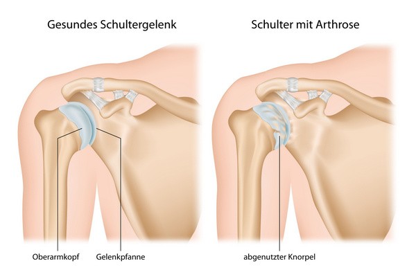 Gelenkverkalkung im Schultergelenk (© bilderzwerg / Fotolia)