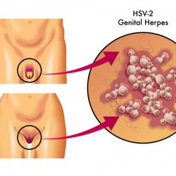 Genital Herpes Genital Herpes (© rob3000 - Fotolia.com)
