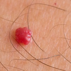 Genital Warzen: Eindeutig diagnostizieren, umgehend behandeln Warze, Angiom oder Leberfleck? - Wer nicht genau weiß, was er da im Intimbereich an Hautveränderung oder Hautwucherung hat, muss das dringend mit einem Arzt klären. Denn: Mit Genital-Warzen ist nicht zu scherzen. (© F.C.G. - Fotolia.com)