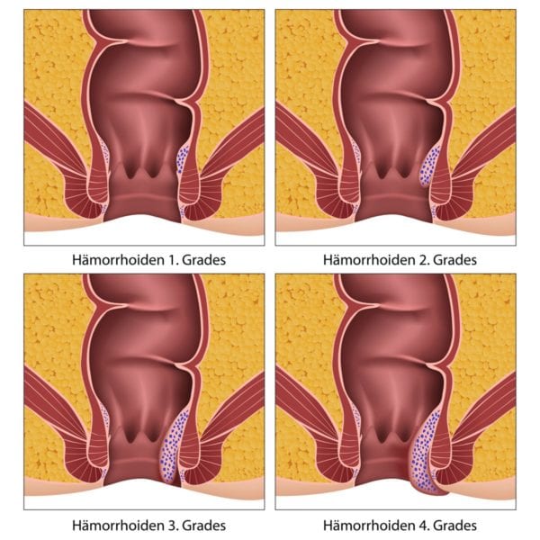 Hämorrhoide Grad 1-4 | Hämorrhoiden Erkrankungsgrade (© bilderzwerg / Fotolia)