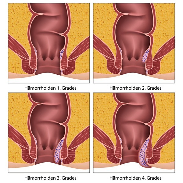 Hämorrhoiden Bild: Die verschiedenen Erkrankungsgrade (© bilderzwerg - Fotolia.com)