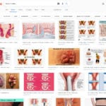 Hämorrhoiden Fotos - Die Google Bilder-Suche liefert informative wie unappetitliche Bilder zu Stichwörtern wie Hemorieden, Hämorieden, Hemoriden, Hämorriden, Hemoroiden und Hämorrhoide