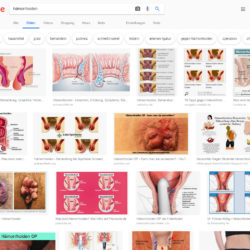 Hämorrhoiden – Was tun, wenn die Probleme unerträglich werden? Hämorrhoiden Fotos - Die Google Bilder-Suche liefert informative wie unappetitliche Bilder zu Stichwörtern wie Hemorieden, Hämorieden, Hemoriden, Hämorriden, Hemoroiden und Hämorrhoide