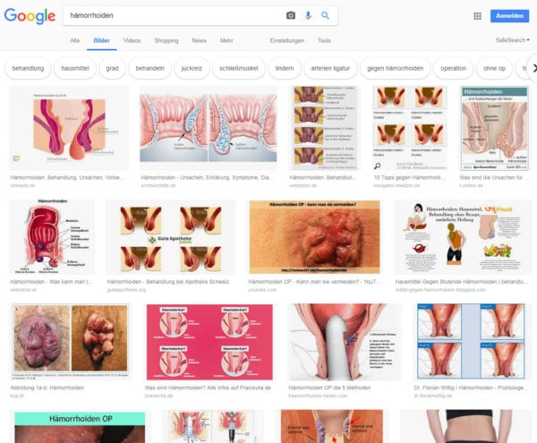Hämorrhoiden Fotos - Die Google Bilder-Suche liefert informative wie unappetitliche Bilder zu Stichwörtern wie Hemorieden, Hämorieden, Hemoriden, Hämorriden, Hemoroiden und Hämorrhoide