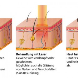 Lasertechnik in der Dermatologie: Bei welchen Problemen auf der Haut im Einsatz? Lasertechnik in der Dermatologie: Behandlung von Hautproblemen wie Akne, Operationsnarben, Pigmentflecken, Tattoos etc. (© bilderzwerg / Fotolia)