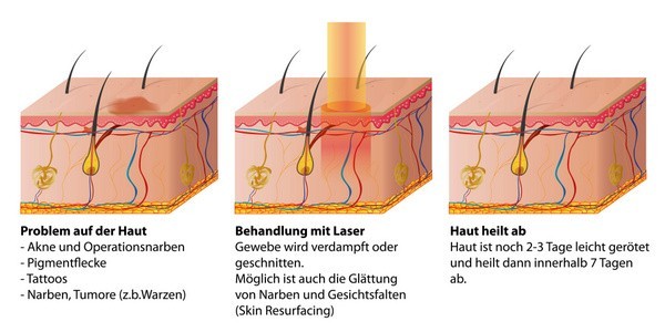 Lasertechnik in der Dermatologie: Behandlung von Hautproblemen wie Akne, Operationsnarben, Pigmentflecken, Tattoos etc. (© bilderzwerg / Fotolia)