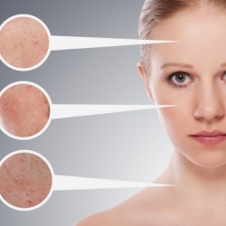 Hautverjüngung: Methoden für ein jüngeres Hautbild – IPL, Faltenglättung und mehr Hautverjüngung: Es gibt verschiedene Methoden und Techniken mit Namen wie Skin-Tightening, IPL, Thermolyse oder auch nur die 'einfache' Behandlung mit Hyaluronsäure (© evgenyatamanenko - Fotolia.com)