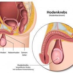 Hoden Schmerzen: Mögliche Ursachen im Überblick Hoden Schmerzen aufgrund von Hodenkrebs? (© bilderzwerg - Fotolia.com)