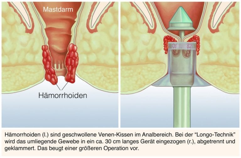 Hämorrhoiden Was tun, wenn die Probleme unerträglich werden? Hämorrhoiden Was tun, wenn die Probleme unerträglich werden?
