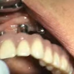 Implantatgetragene Prothese: Zahnprothese auf Implantaten Implantatgetragene Zahnprothese: Eine Vollprothese für den Oberkiefer hält über in den Kiefer eingebrachte Implantate - Haftcreme adé (Screenshot aus Youtube-Video KO-uXqVaG0E)