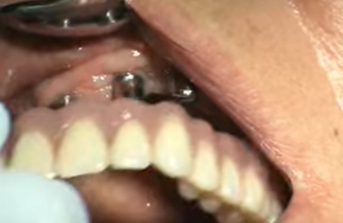 Implantatgetragene Zahnprothese: Eine Vollprothese für den Oberkiefer hält über in den Kiefer eingebrachte Implantate - Haftcreme adé (Screenshot aus Youtube-Video KO-uXqVaG0E)