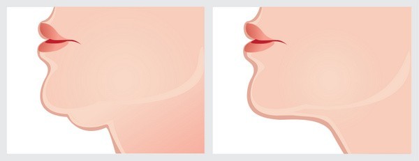 Kinnstraffung vorher nachher (© ladahunt - Fotolia.com)