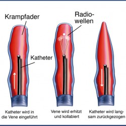 Krampfadern modern behandeln Krampfadern modern behandeln: hier mit Katheter und Radiowellen (© Henrie - Fotolia.com)