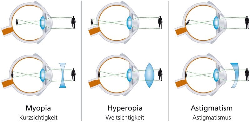 Kurzsichtigkeit (Myopie), Weitsichtigkeit (Hyperopie) und Hornhautverkrümmung (Astigmatismus): Durch Linsenimplantate in Form von ICL Linsen / Intraokularlinsen können verschiedene Formen von Fehlsichtigkeit korrigiert werden. Dies kann in Kombination mit einer Augenlaserbehandlung geschehen (Bioptics-Verfahren), oder aber die Augenlinsen OP wird als Alternative zur Lasik durchgeführt, wenn z.B. die Hornhaut zu dünn für das Augenlasern ist. (© Peter Hermes Furian / Fotolia)