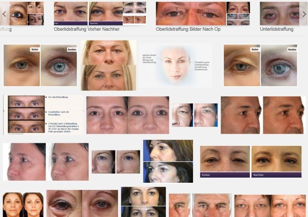 Lidstraffung Bilder: Eine Recherche nach 'Lidstraffung' in der Google Bildersuche liefert Beispiele von Behandlungen (Screenshot Google Bildersuche)
