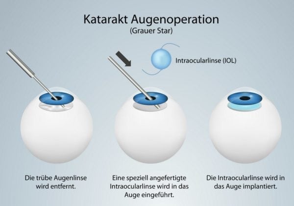 ICL Linsen & Intraokularlinsen: Linsenimplantate statt oder mit LASIK?