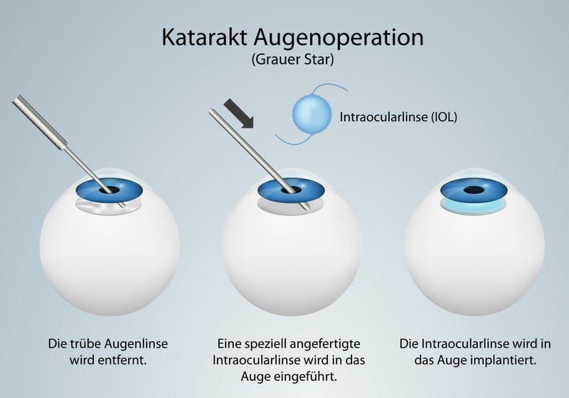 Linsentausch / Linsenimplantation von IOL (Intraokularlinsen) im Rahmen einer Kataraktbehandlung (Augenlinsen OP zur Behandlung einer eingetrübten Linse; grauer Star) (© bilderzwerg / Fotolia)