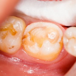 Mundschleimhautentzündung: Symptome und Behandlung (inkl. Hausmittel) Mundschleimhautentzündung und verschmutzte Zähne (© Sandor Kacso - Fotolia.com)