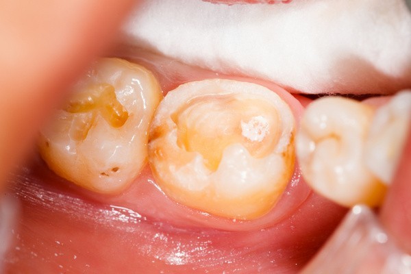 Mundschleimhautentzündung und verschmutzte Zähne (© Sandor Kacso - Fotolia.com)