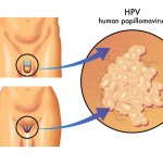 HPV / Humaner Papilloma Virus an Genitalien (© rob3000 - Fotolia.com)