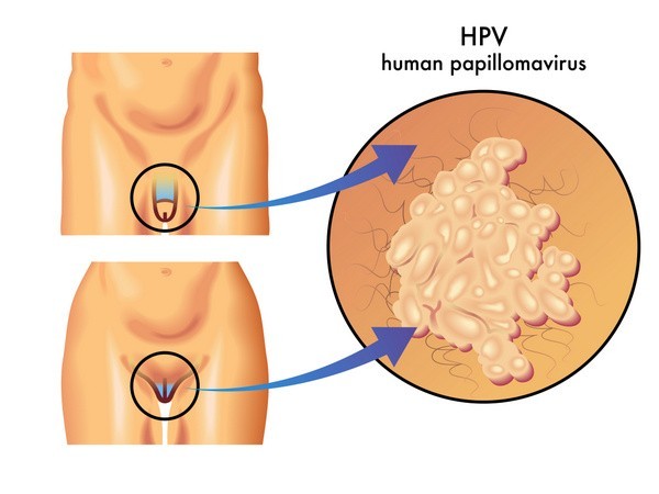 HPV / Humaner Papilloma Virus an Genitalien (© rob3000 - Fotolia.com)