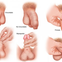Balanoposthitis (Eichel-/Vorhautentzündung) © Alexilus - Fotolia.com