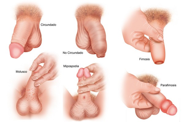 Aussehen eichelpilz Balanitis: Entzündung